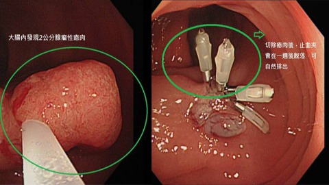 大腸鏡