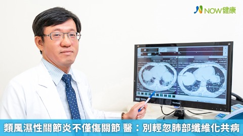 類風濕性關節炎不僅傷關節 醫：別輕忽肺部纖維化共病