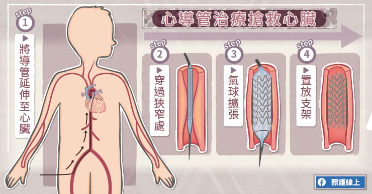 心導管治療搶救心臟