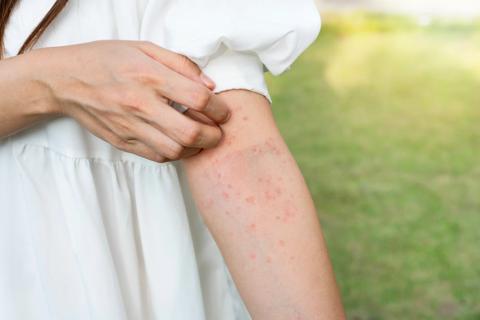 Arms of person standing outside, scratching a dotted red rash on arm