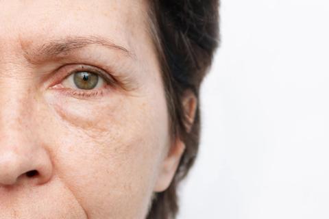 Close up of half a person's face with puffy under eye bag