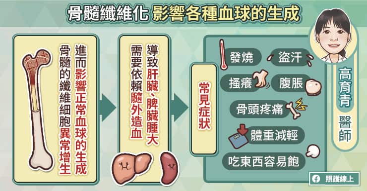 骨髓纖維化影響各種血球生成