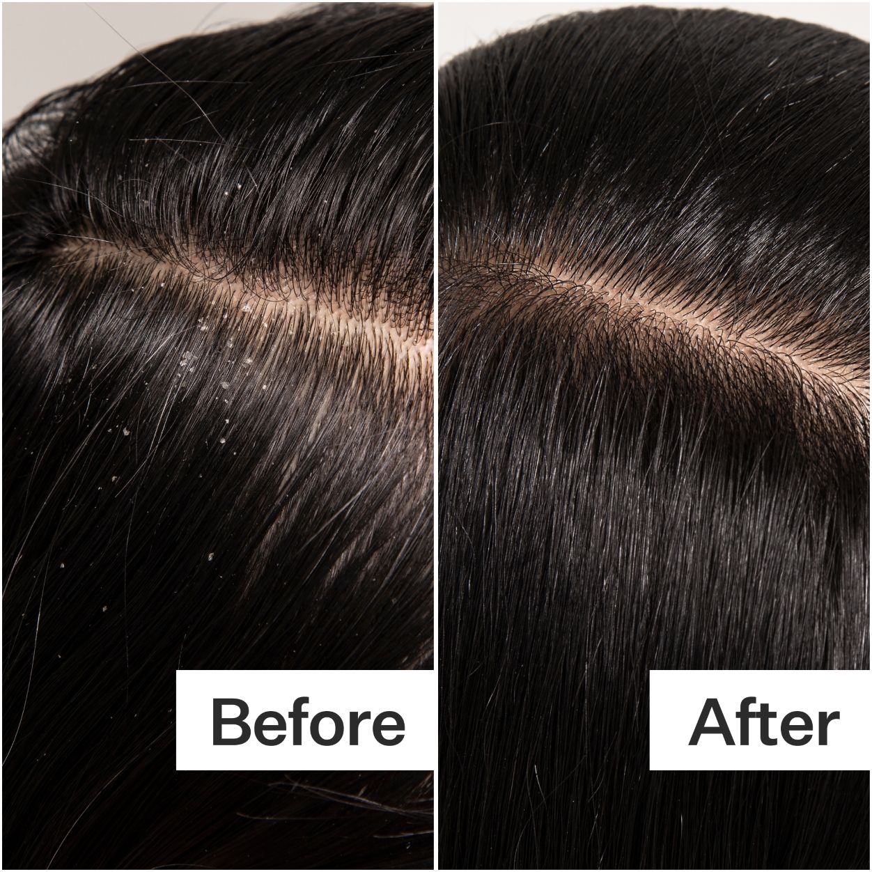 Before and after results of using Act+Acre Cold Processed Scalp Detox