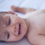 Crying baby girl with measles