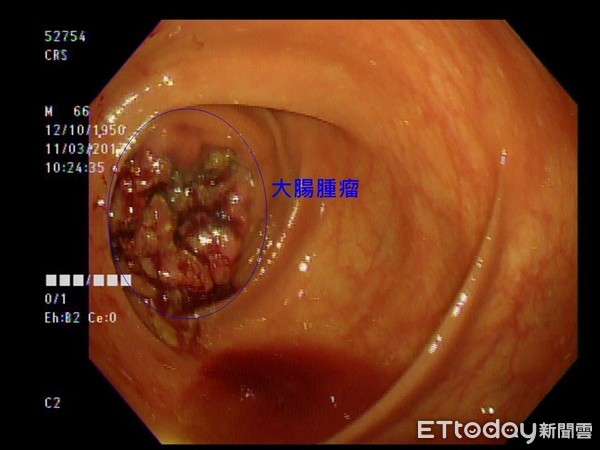 ▲腹痛5年當胃痛醫，竟是大腸癌末期。（圖／亞大附醫提供）