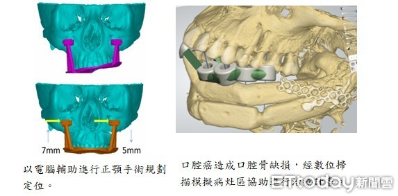 ▲以電腦輔助進行正顎手術規劃及口腔癌造成口腔骨缺損，經數位掃描模擬病灶區協助進行手術規畫定位。