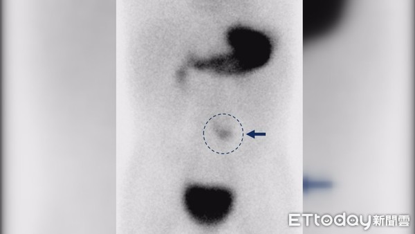 ▲圓圈處為核醫檢查梅克爾憩室顯影處。（圖／記者黃孟珍翻攝）