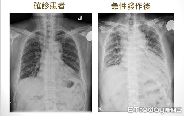 ▲▼常感到喘、咳嗽？當心罹患「菜瓜布肺」影響肺功能               。（圖／記者陳家豪攝）