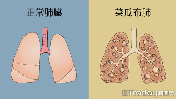 ▲▼常感到喘、咳嗽？當心罹患「菜瓜布肺」影響肺功能               。（圖／記者陳家豪攝）