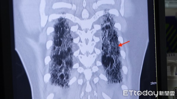 ▲肺部纖維化惡化之後，會出現像是菜瓜布一樣的情況             。（圖／記者吳奕靖攝）