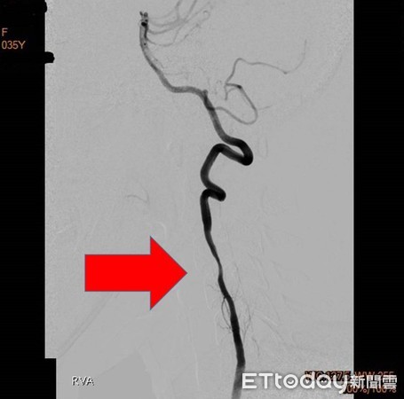 ▲血管攝影檢查可看到OL頸部椎動脈有部分狹窄情況，使得動脈管徑粗細不均。（圖／高醫提供）