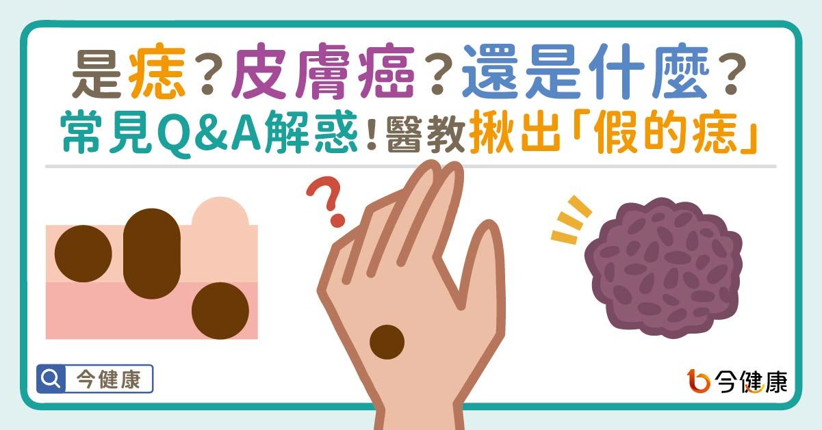 ▲▼是痣or皮膚癌？醫「1張圖秒對照」　長2部位最危險。（圖／今健康授權提供）