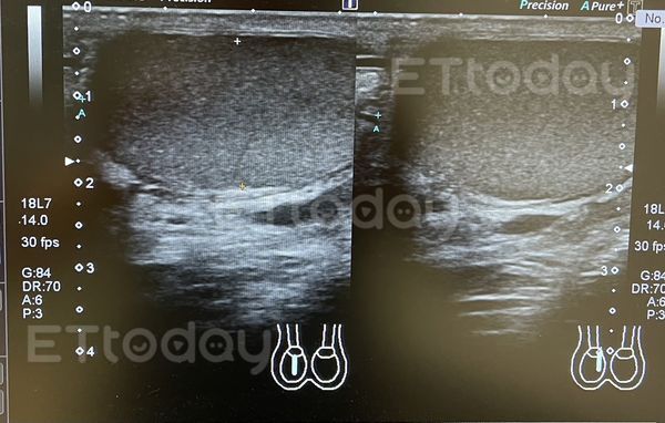 ▲侯先生經過超音波檢查，確認睪丸沒有受傷             。（圖／記者吳奕靖翻攝）