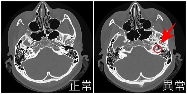 ▲▼耳硬化症是因鐙骨骨質海綿化及硬化(圖右)，導致出現傳導性聽力損失。（圖／亞大附醫提供）