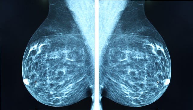 mammogram radio imagingr breast cancer diagnosis