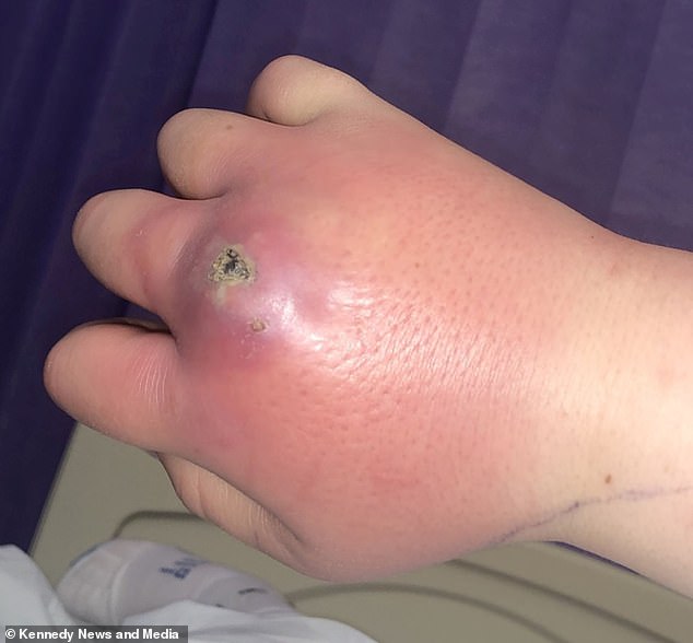 Morgan Curran, 21, from Oxfordshire, was bitten by a false widow spider and saw her hand swell up like a 'boxing glove'