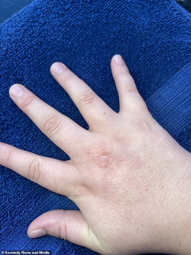 Her hand has recovered since the operation in April 2019 but a mark remains and sometimes it is still painful