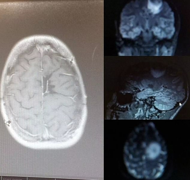 It was only after the now 33-year-old blacked out again twice at the gym that she sought further medical attention. An MRI scan showed she had a golf-ball sized tumour on her brain