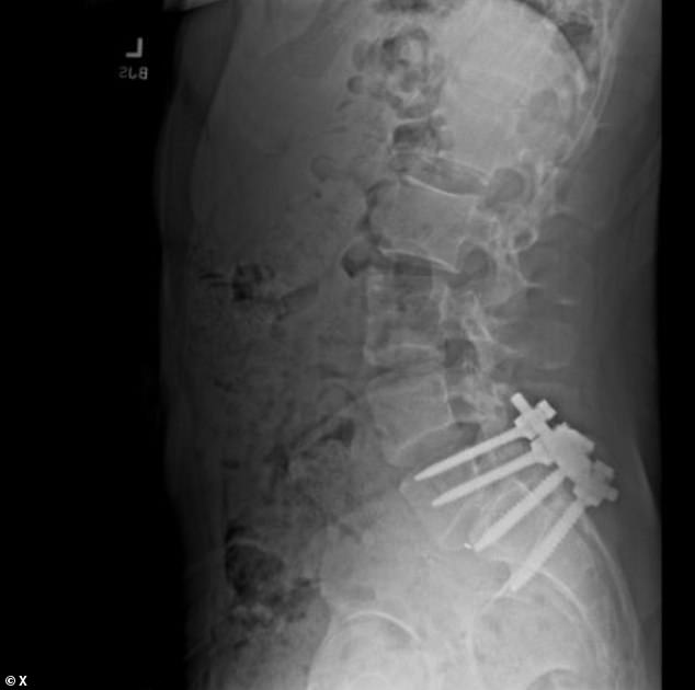 An image posted to an X account linked to Mangione showed what appeared to be an X-ray of a metal rod and multiple screws inserted into his lower spine