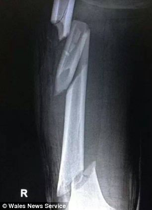 An xray showing the skydiver's femur broken in 3 places