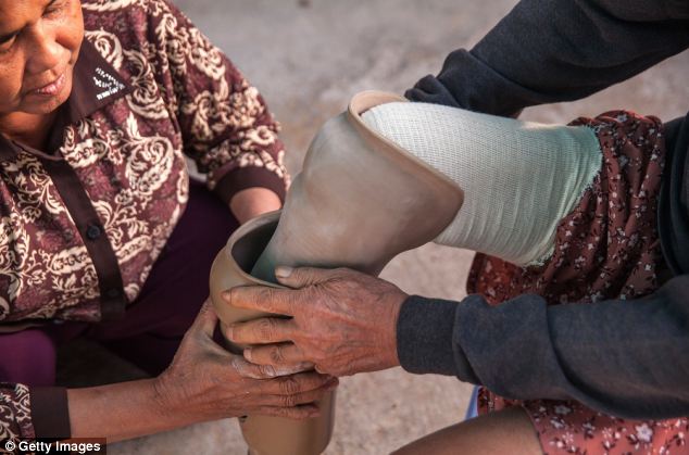 Getting started: A female patient is helped in to her replacement leg by a staff member