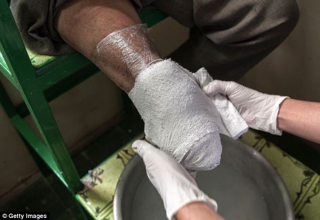 Dressing: A patient's limb is covered with plaster to make a mould for a prosthetic limb