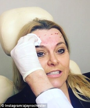 Turning back time: The 47-year-old shows off bloody forehead from where the injections had pricked her face