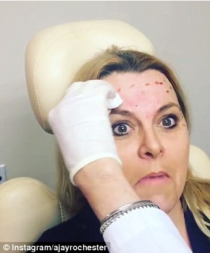 Turning back time: The 47-year-old shows off bloody forehead from where the injections had pricked her face