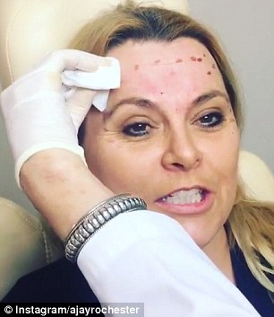 'So this is five days in from my Botox!' Ajay  displayed the results of her recent Botox injections in a video posted to Instagram earlier on Wednesday