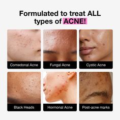 This first-of-its-kind non-gel formula combines ceramides & emollients with over 23% clinically proven ingredients to repair the skin barrier while healing & preventing different types of acne fast. Whether your acne is comedonal, cystic, hormonal, or fungal, get ready for visibly clearer skin without sacrifcing moisture & hydration. Fungal Acne Skin Care Routine, Closed Comedones, Comedonal Acne, Different Types Of Acne, Blind Pimple, Fungal Acne, Pimples Under The Skin, Acne Prone Skin Care, Bad Acne