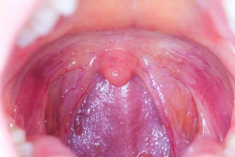 Remedies For Swollen Tonsils, Swollen Tonsils, Throat Pain, Throat Infection, Strep Throat, Poor Nutrition, Healthy Substitutions, Healthy Lifestyle Habits, Cleveland Clinic