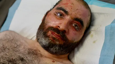 Mohammed lies on a hospital bed, his eyes looking directly at the camera. He has short hair and a brown beard, and his face shows signs of burn injuries around the forehead, eyes and cheeks.   