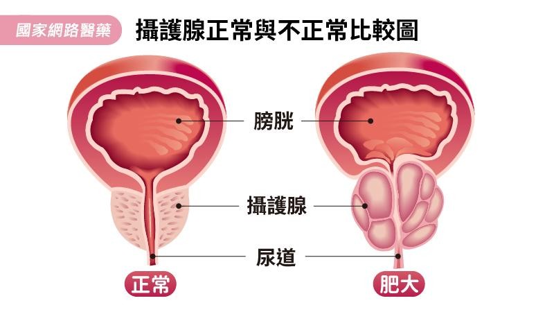 ▲攝護腺肥大。（圖／國家網路醫藥）