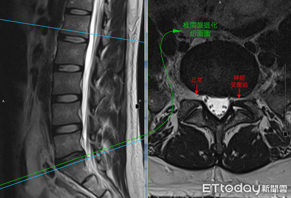 ▲32歲男「腰間盤突出退化如80歲老翁」。（圖／光田綜合醫院提供）