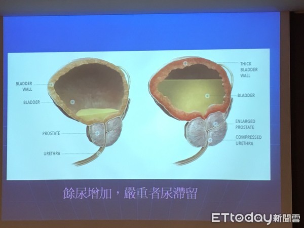 ▲頻尿又餘尿多 當心已是慢性尿滯留。（圖／記者嚴云岑攝）