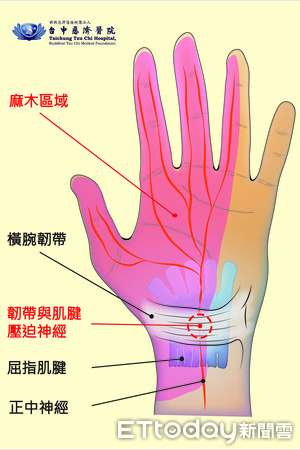 ▲圖說001臺中慈濟醫院復健科李信賢醫師表示，腕隧道症候群病人要減少手腕使用量。002腕隧道道症候群病人配帶副木約六成三個月內會痊癒。003腕隧道症候群自我檢查方式，法倫氏檢查（Phalen test）。004腕隧道症候群示意圖。（圖／台中慈濟醫院提供）