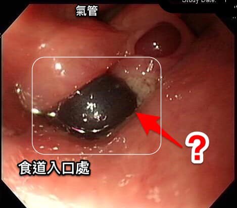 ▲▼食道血腫。（圖／錢政弘醫師提供）