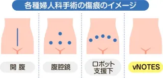 おなかに全く傷が付かない婦人科手術　良性疾患の大半で可能　痛み少なく