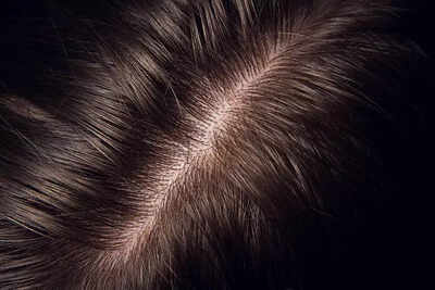 Decoding scalp health: How it impacts hair growth and loss