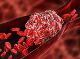 Which is the most common body part to get a blood clot (why is it so and how to avoid this)