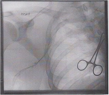 A venogram before catheter-directed thrombolysis for Paget–Schroetter syndrome, a rare and severe arm DVT shown here in a judo practitioner, with highly restricted blood flow shown in the vein