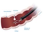 Vorschaubild für Koloskopie
