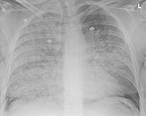 An X-radiograph of the chest of a patient with aspiration pneumonia