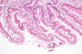 Micrografía mostrando giardiasis en biopsia duodenal.