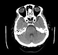 Computed tomography (CT)