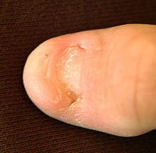 Big toe with most of the toenail missing; only the nail's root is present