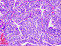 Adénocarcinome endométrioïde, vue d'une biopsie. Coloration HE.