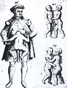 Illustrazione di un uomo adulto con un gemello parassita e due coppie di gemelli siamesi dall'edizione del 1609 di Monstrorum historia memorabilis di Johann Schenk.