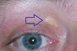 Image illustrative de l’article Xanthelasma