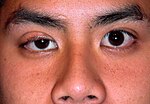 Thumbnail for File:Congenitalptosis.JPG